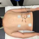 Fisioterapia para el manejo del dolor - Electroterapia