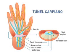 ¿Qué es el síndrome del túnel carpiano y qué afecta?