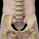 Hernia Discal Mitos - SKÁL Fisioterapia Santa Ana
