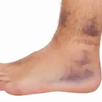 Grados del Esguince de Tobillo, Tratamiento y Recuperación con Fisioterapia