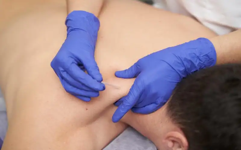 Qué es la punción seca y en qué se diferencia de la acupuntura